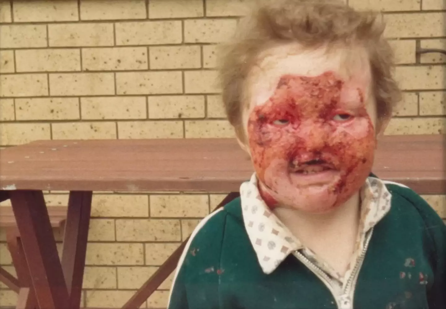 He was born with epidermolysis bullosa and doctors said he wouldn't make it past age 5 (YouTube/ABCScience)