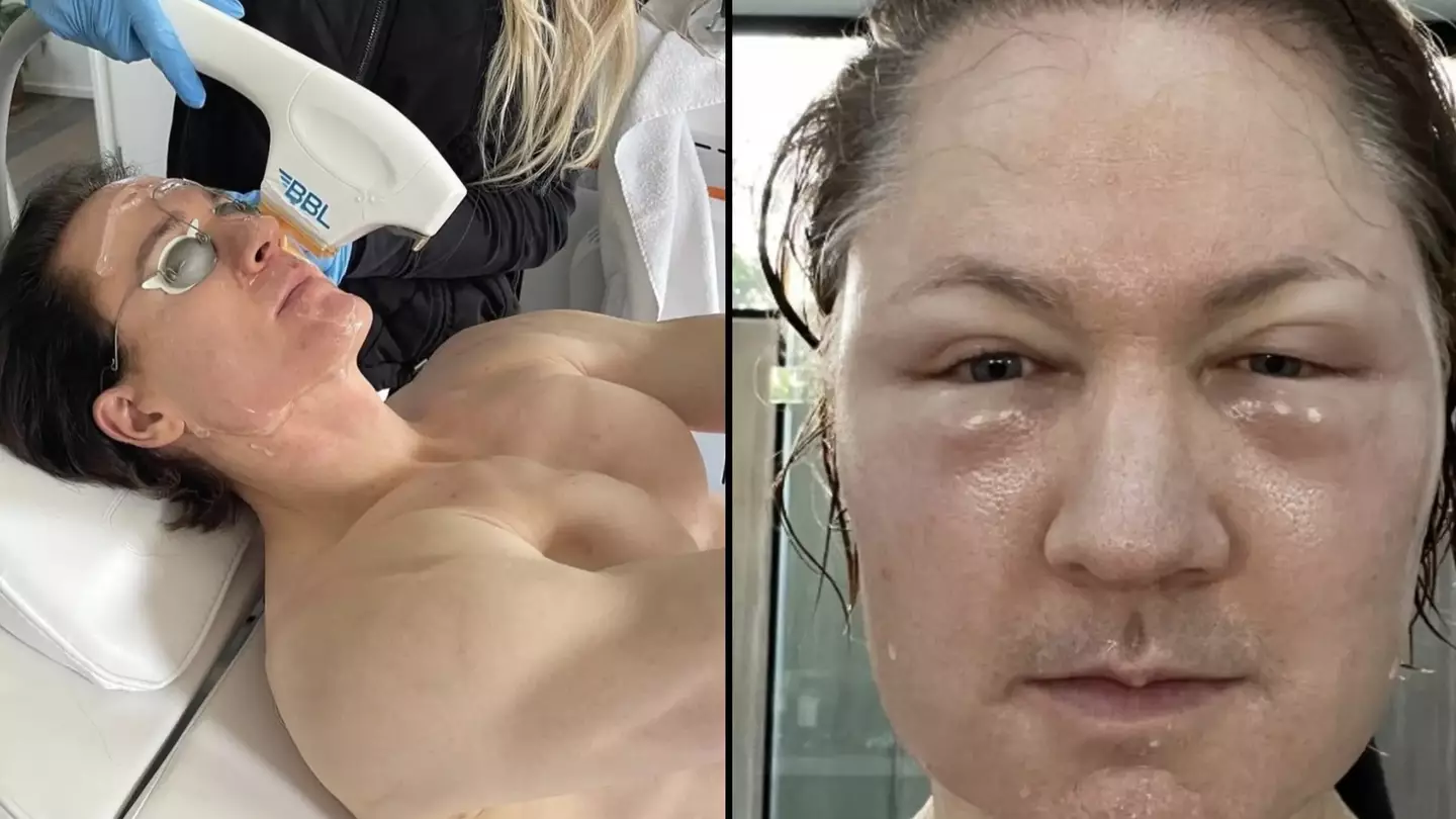 Biohacker who spends $2m a year to get teen body shares horrific thing that happened when he injected fat into face