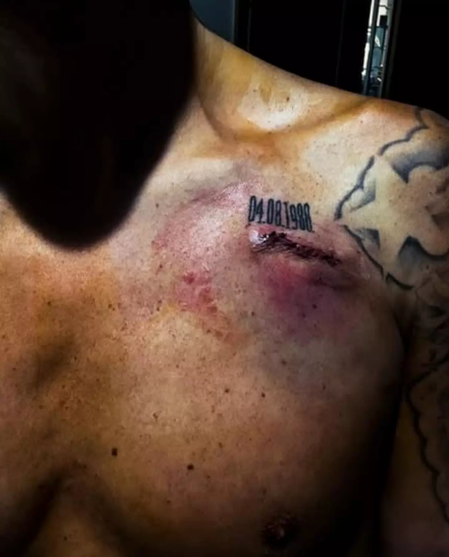 George's pacemaker scar (Instagram/@maxgeorge)