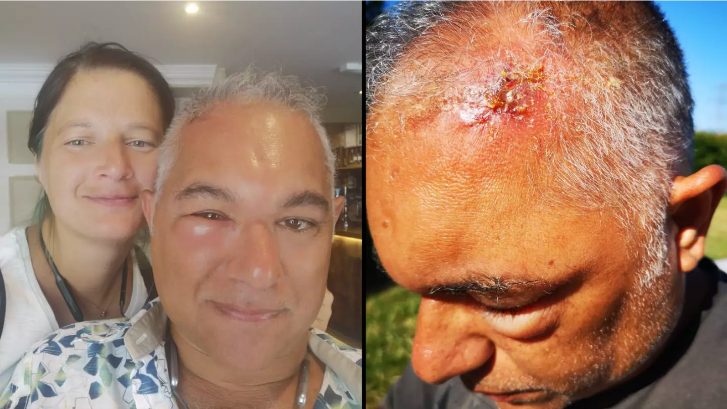 Man bitten on the head by UK's only venomous snake on camping trip blames wife