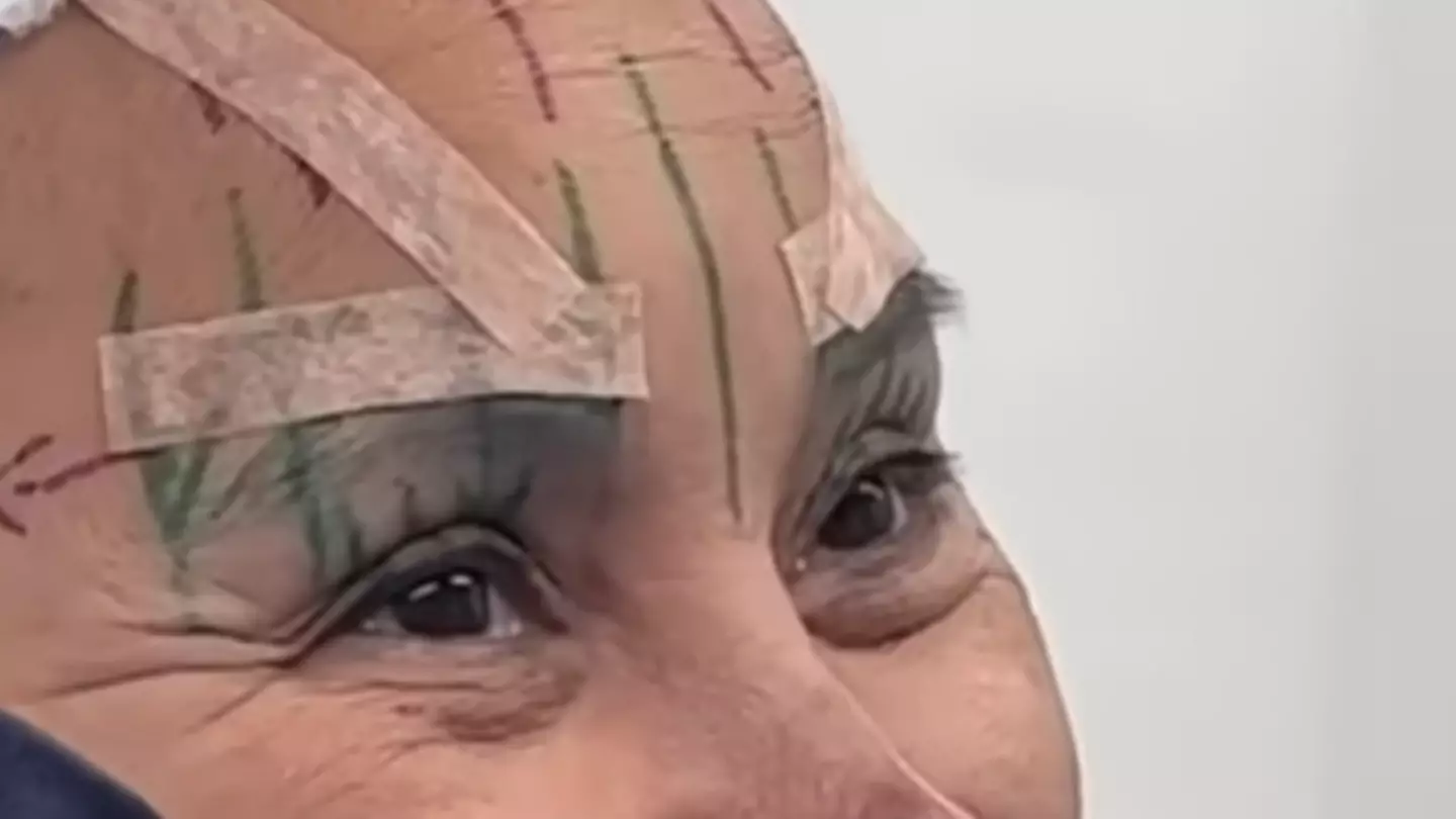 Woman's transformation after 'black swan eyes' surgery is leaving people seriously concerned