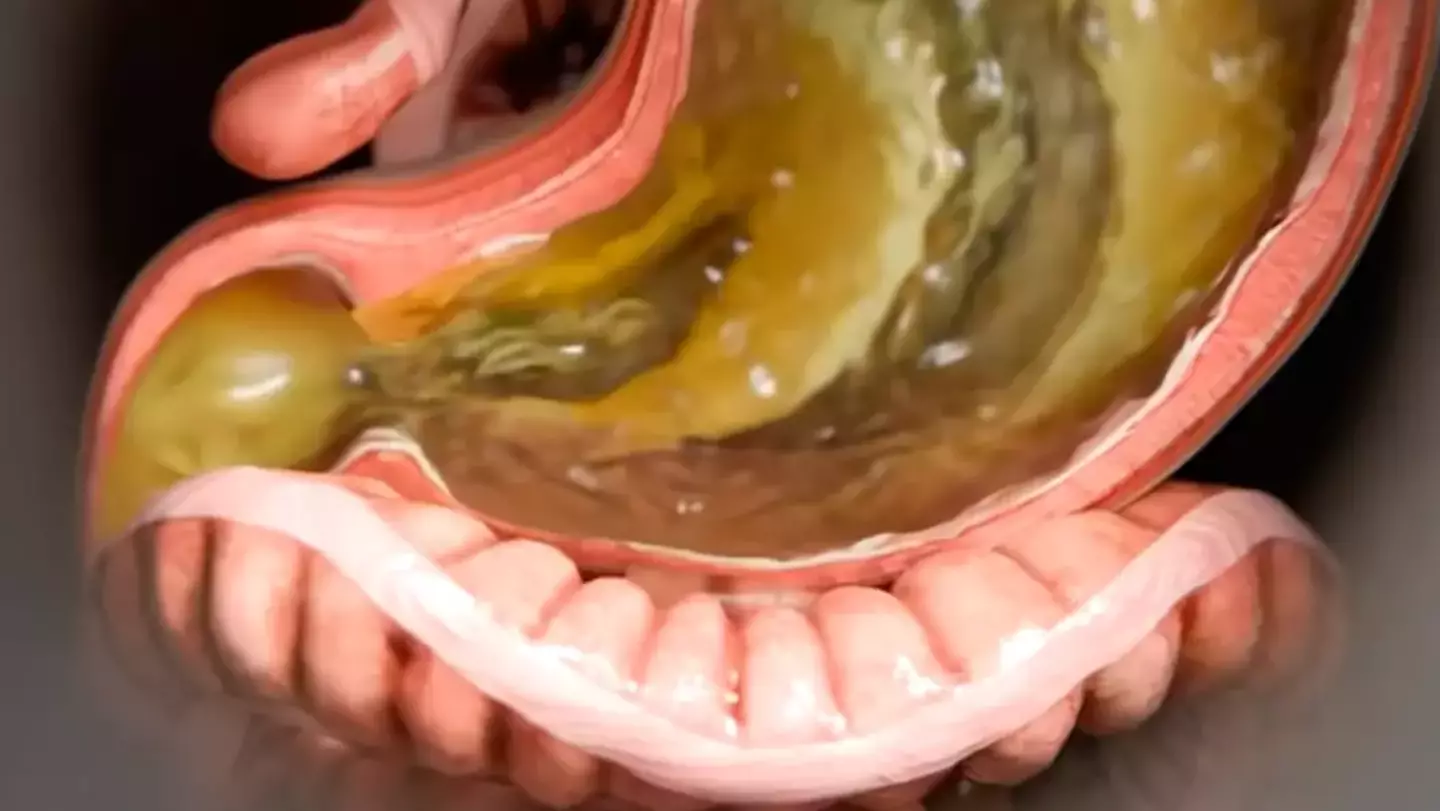 Nausea and Diarrhoea are possible side effects of Ozempic (YouTube/Zack D Films)
