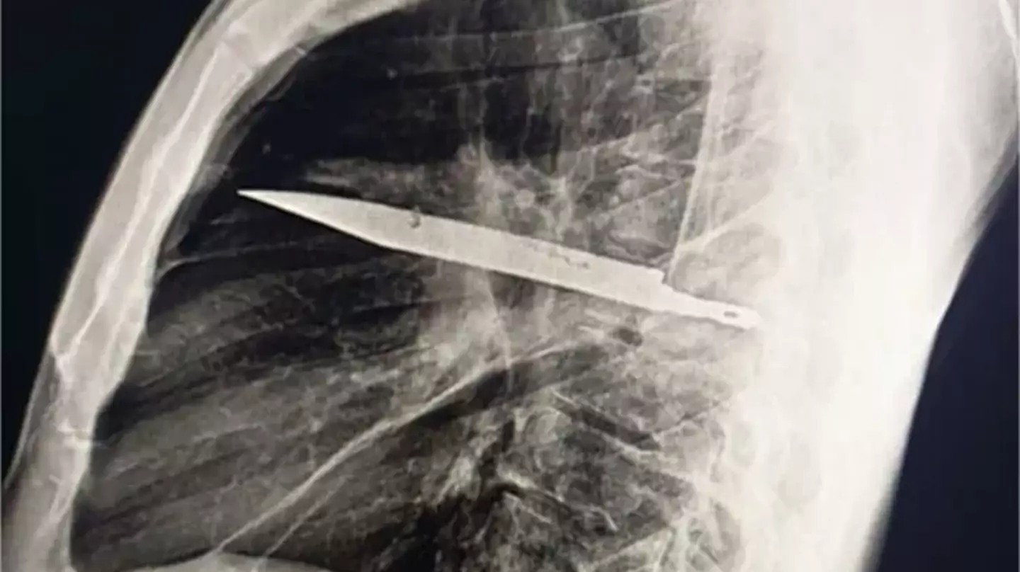 Man who went to hospital as nipple was leaking pus had knife stuck in his chest for eight years