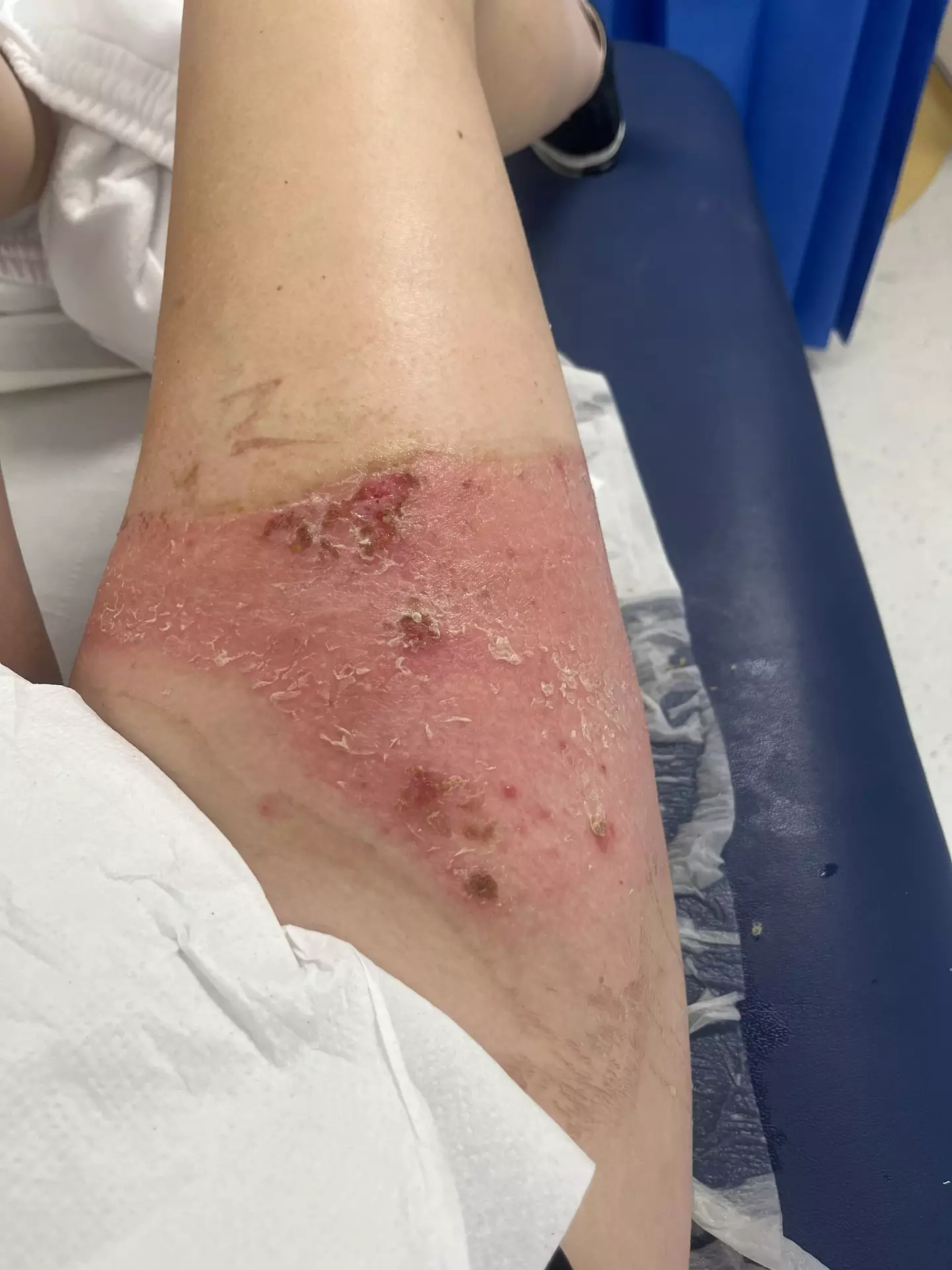 Annie's burns are beginning to heal (Kennedy News and Media)