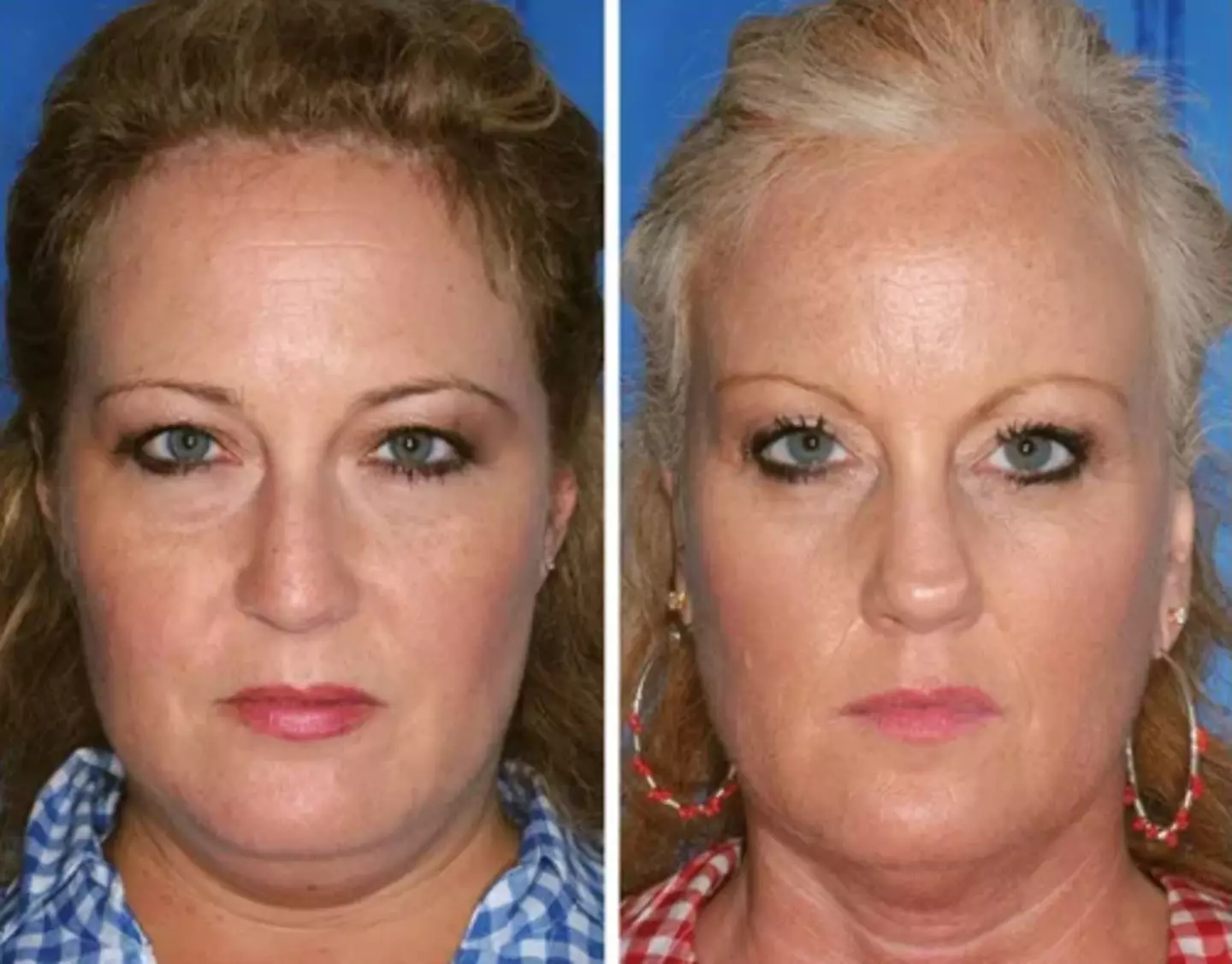The twin on the right is a smoker; the twin on the left is a nonsmoker (American Society of Plastic Surgeons)