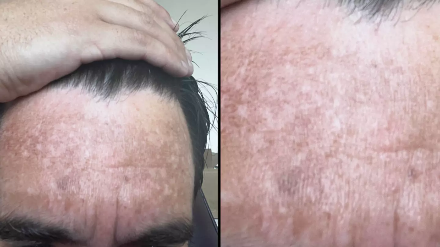 Bloke asks for help after noticing patches appear on forehead