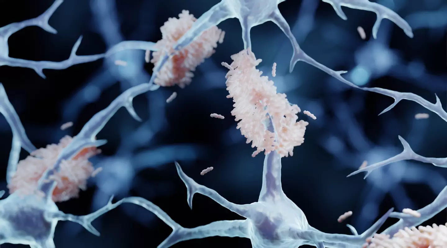 The build-up of amyloid-beta in the brain is believed to be the main cause of Alzheimer's (Getty Stock Image)