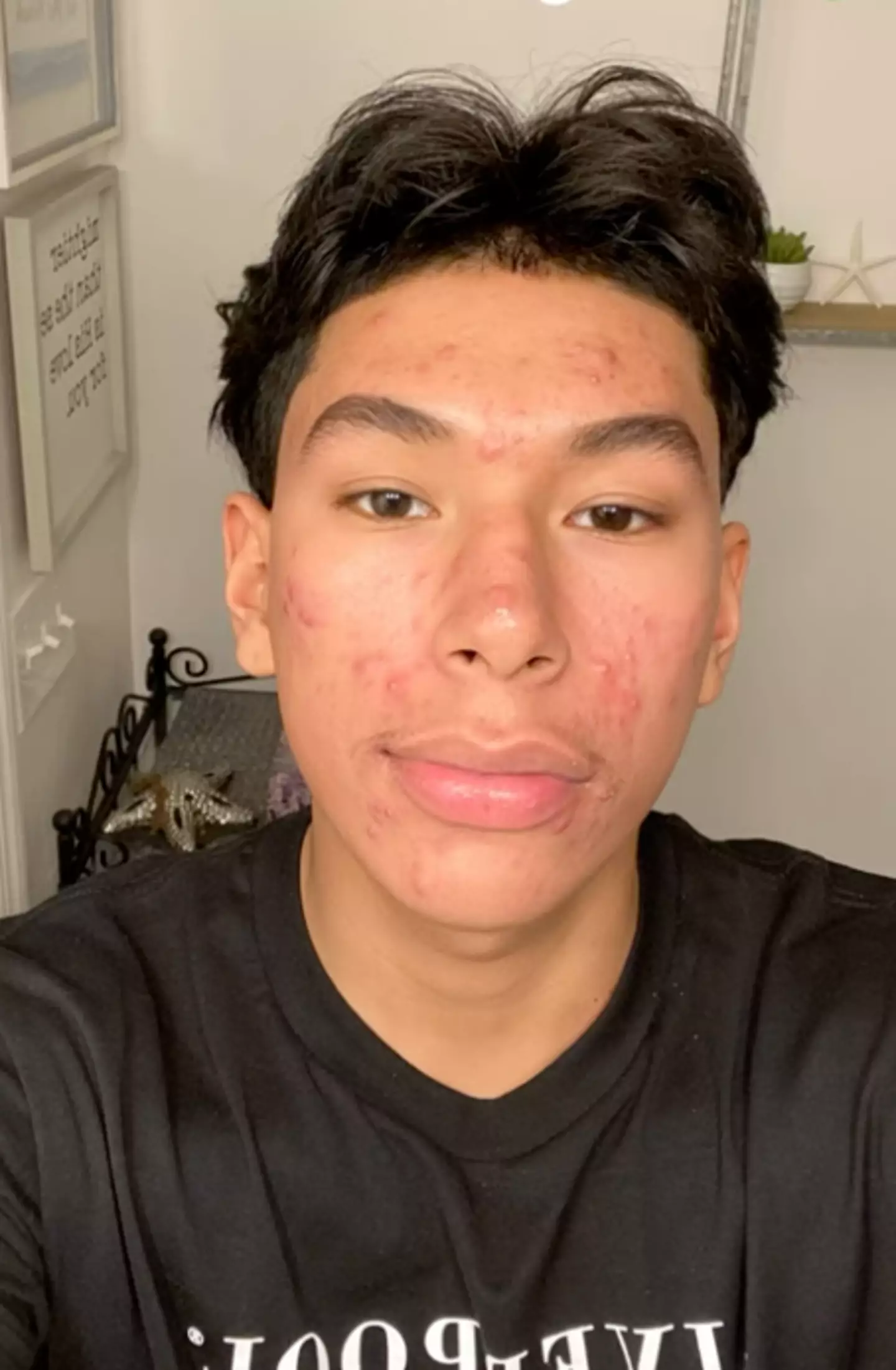 Smoking weed had a detrimental effect on his skin (YouTube/Patrick Merino)