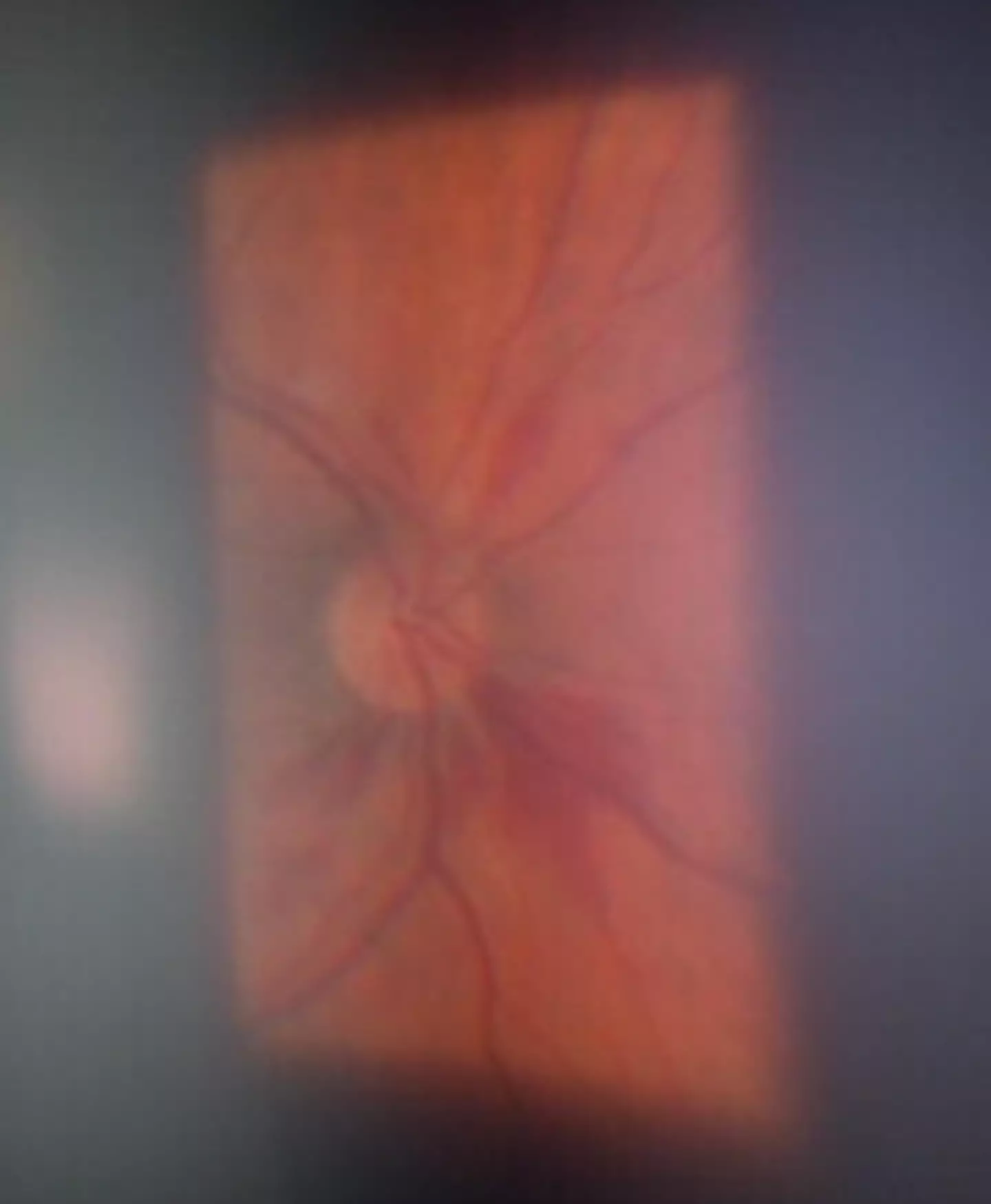 Haemorrhage in a CCHF patient.