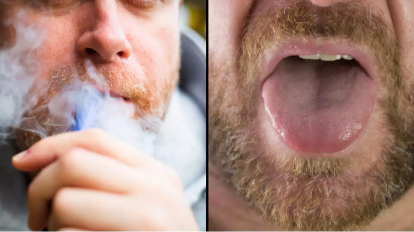 Dentist issues warning over ‘Vaper’s Tongue’