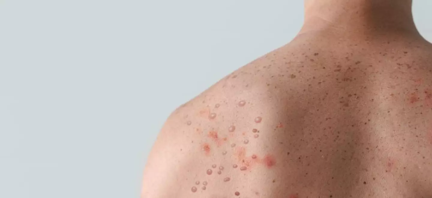 Monkeypox often causes a distinctive rash.