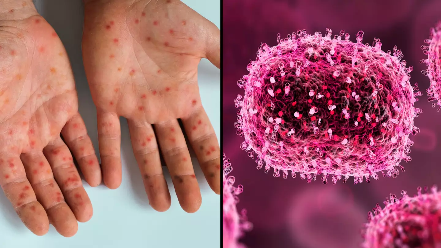 Brits warned about first mpox symptom that might get mistaken for something harmless