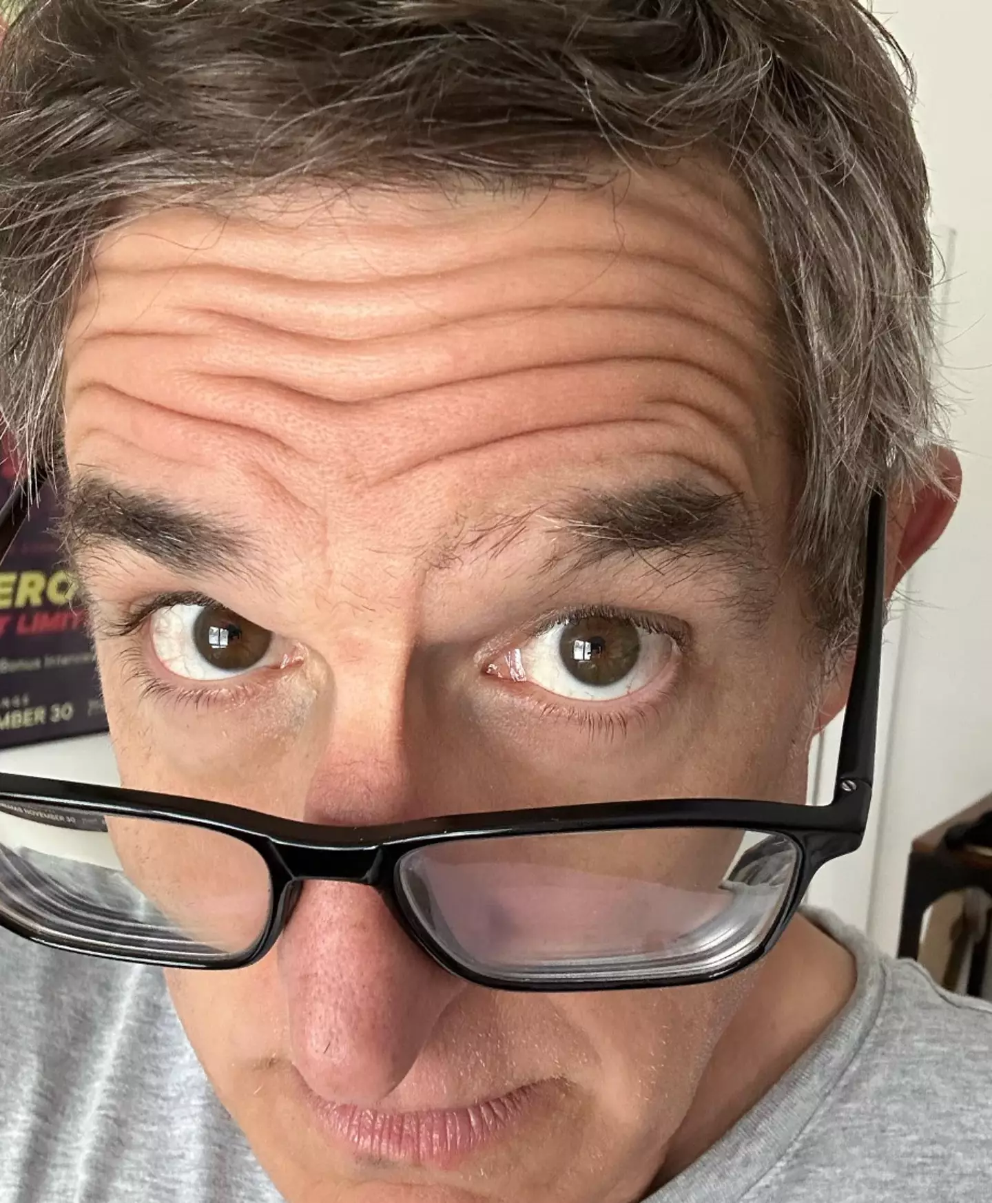 In July, Theroux shared a selfie showing hair loss to his eyebrow.