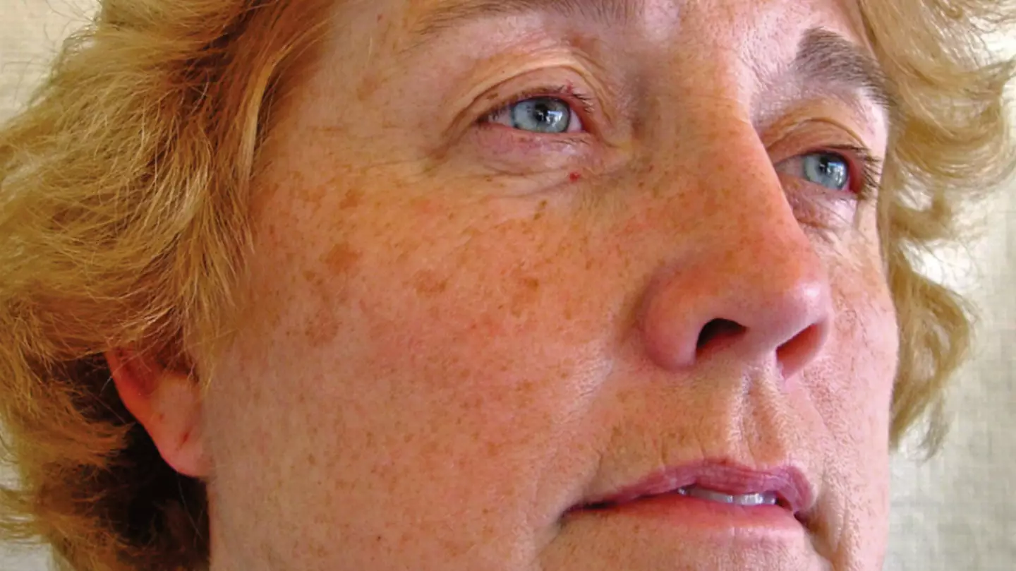 Study on identical twins shows difference in appearance when one smoked and other didn't