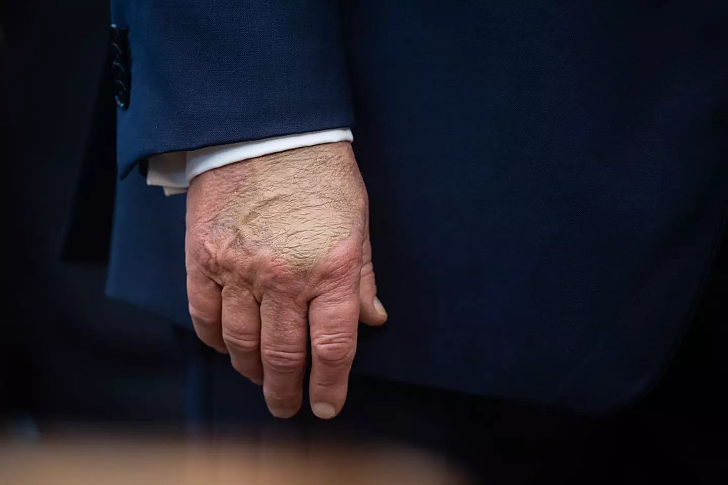 Trump's swollen hands made headlines earlier this year, sparking concern (Francis Chung/Politico/Bloomberg via Getty Images)