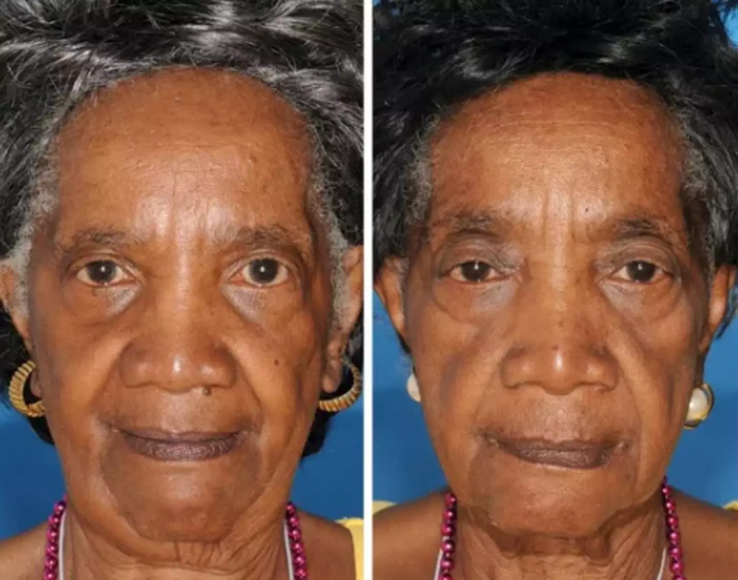 The twin on the left here is a non-smoker. (American Society of Plastic Surgeons)