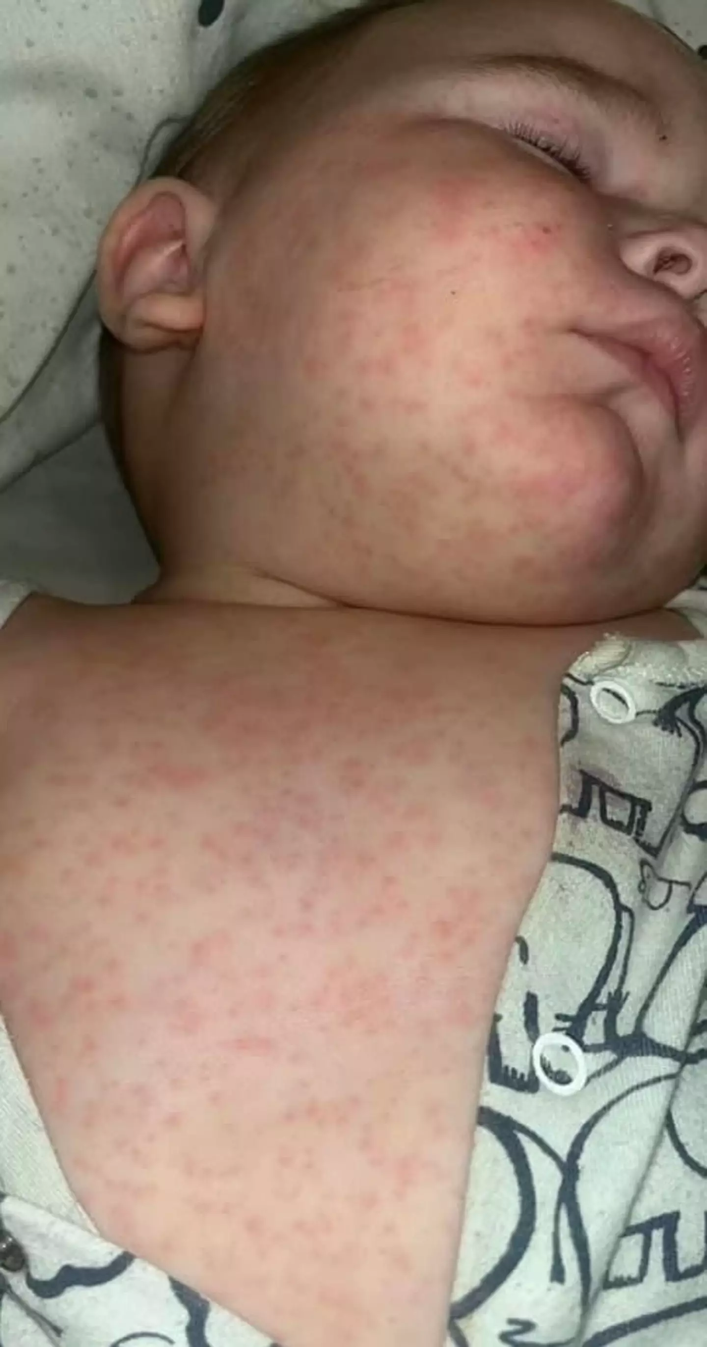 Holly’s baby developed a rash once they returned home to the UK (Collect/PA Real Life)