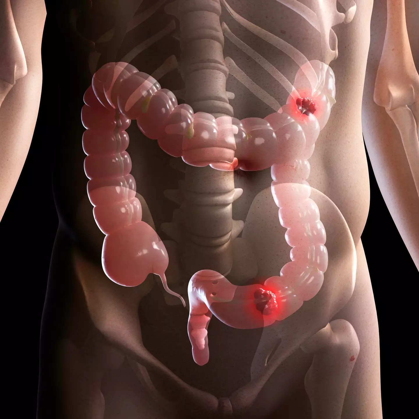 There are roughly 16,800 bowel cancer deaths in the UK every year, according to Cancer Research UK (Getty Stock Images)