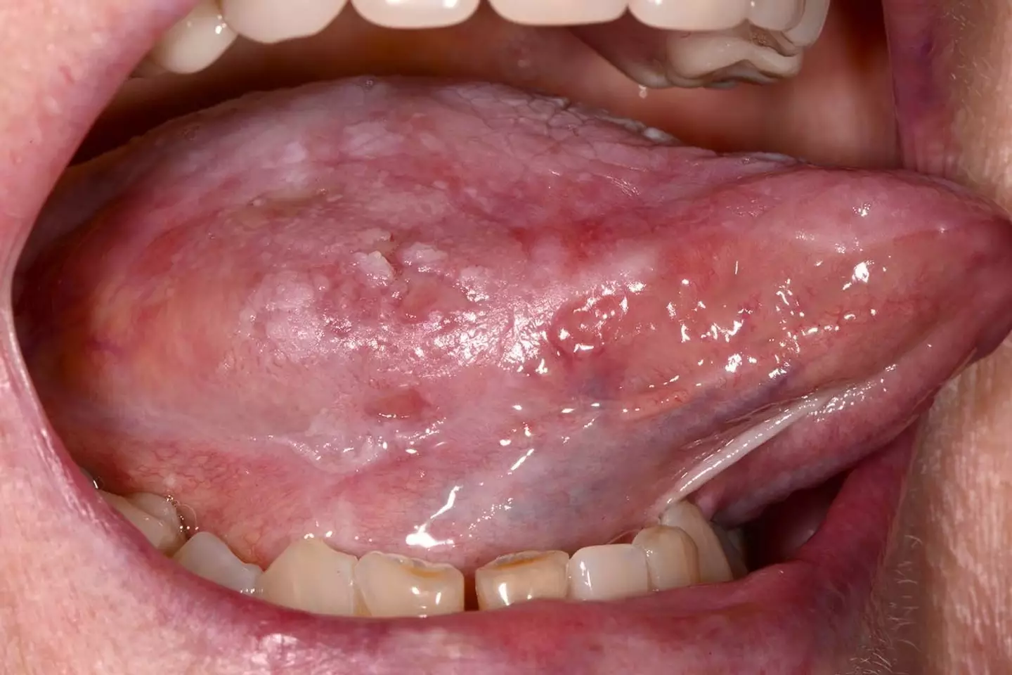 White patches on the tongue or in the mouth could be a sign (NHS)