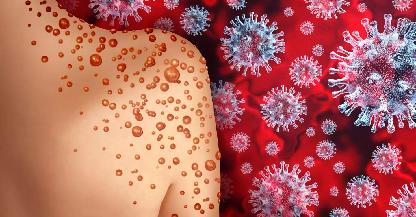 The virus can cause flu-like symptoms before a rash appears.