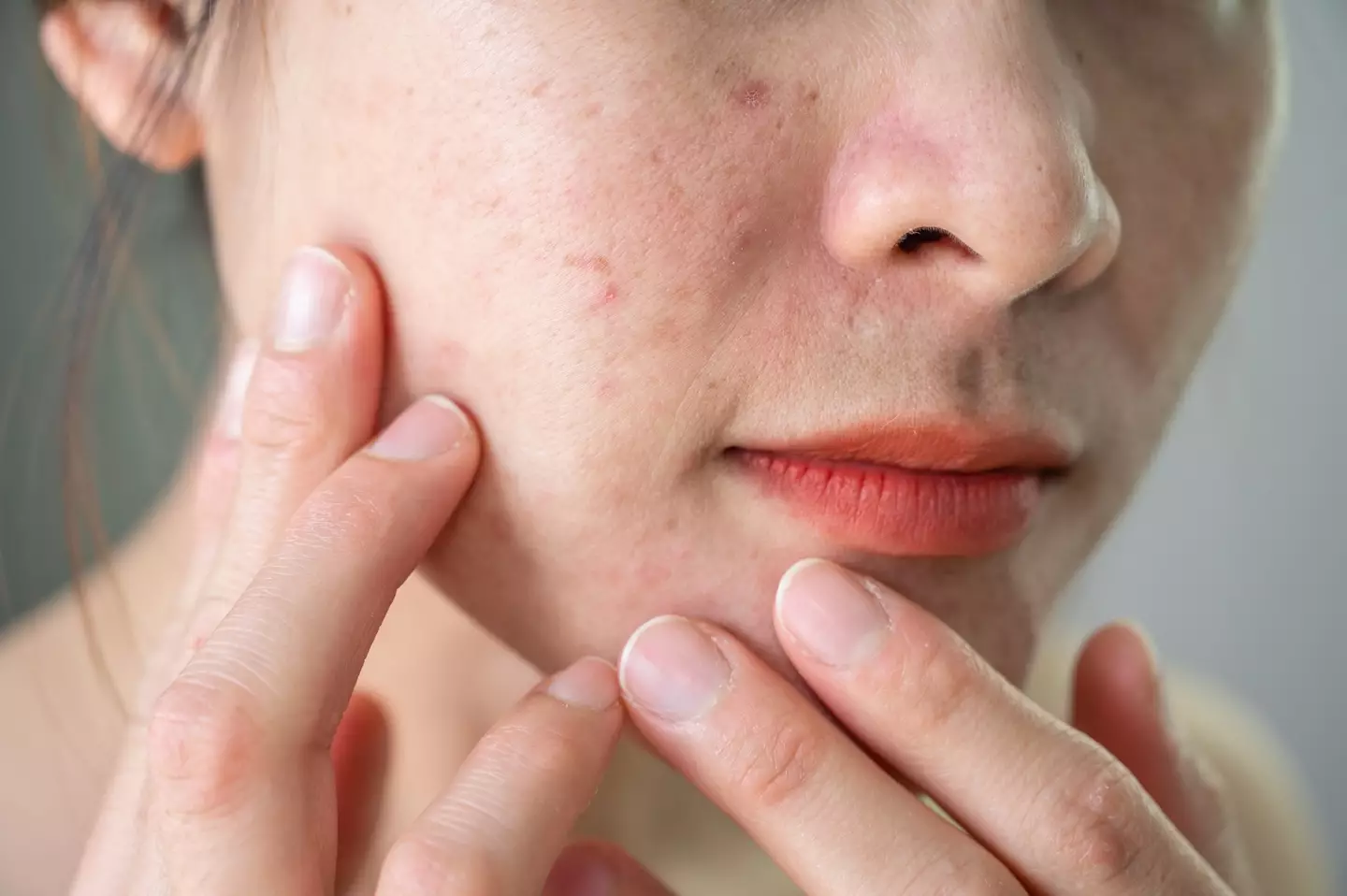 You shouldn't pop pimples in the 'danger triangle' (Getty Stock Photo)