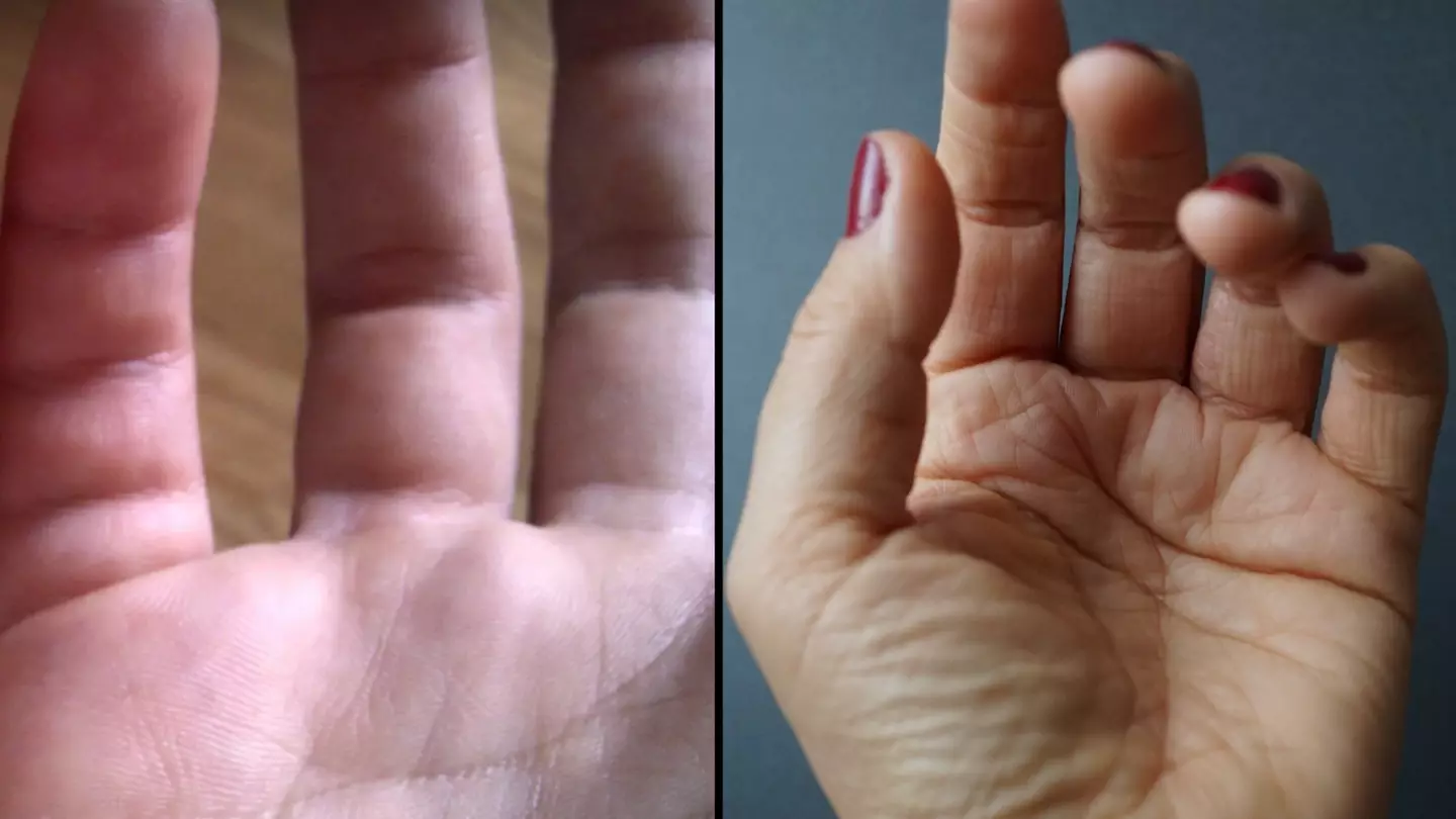 Only a small number of people have an extra crease on their pinky finger
