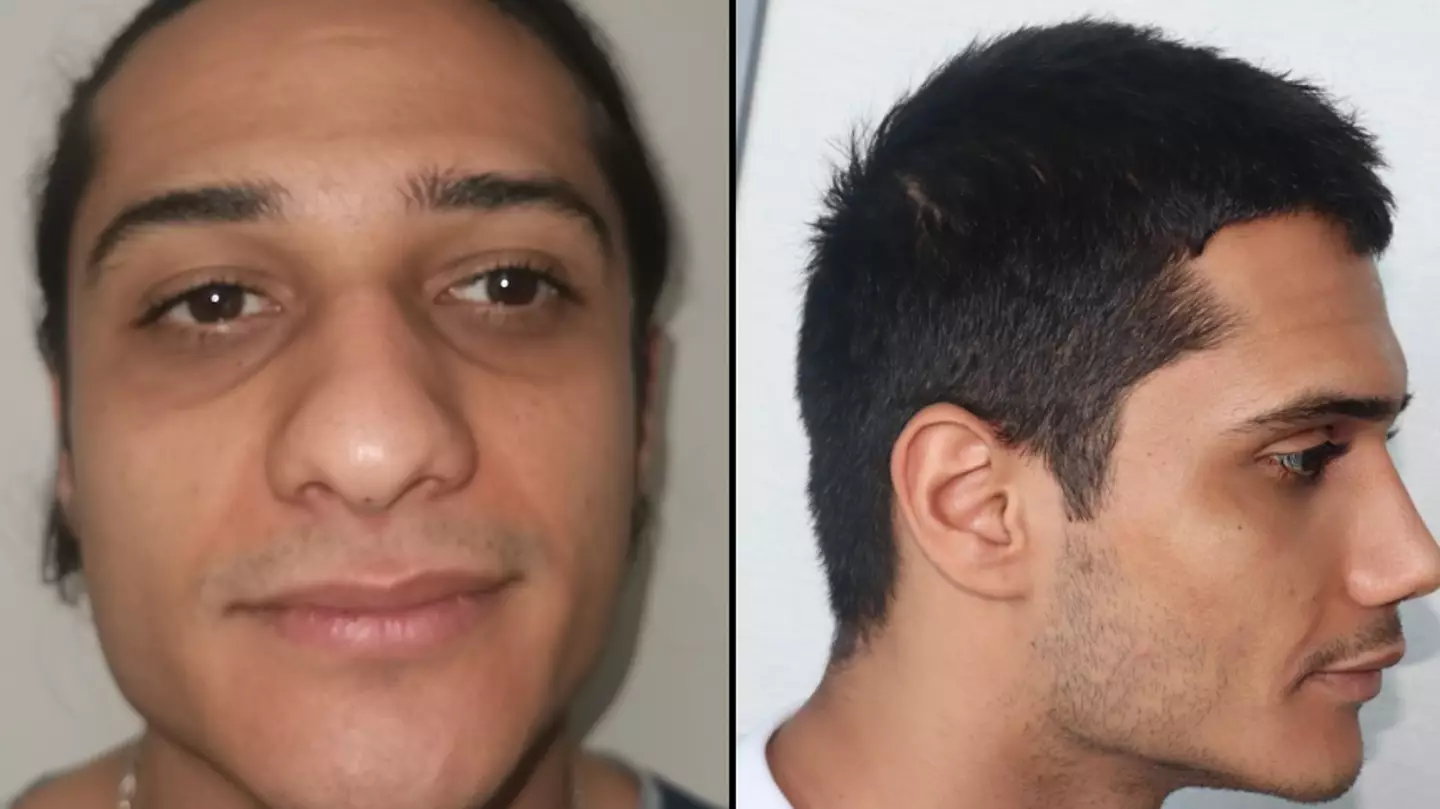 Man will need 'new identity' after Turkish surgery leaves him looking like a completely different person