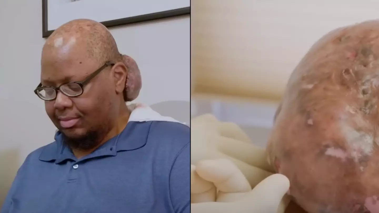 People are all asking the same thing after watching man get enormous tumour removed