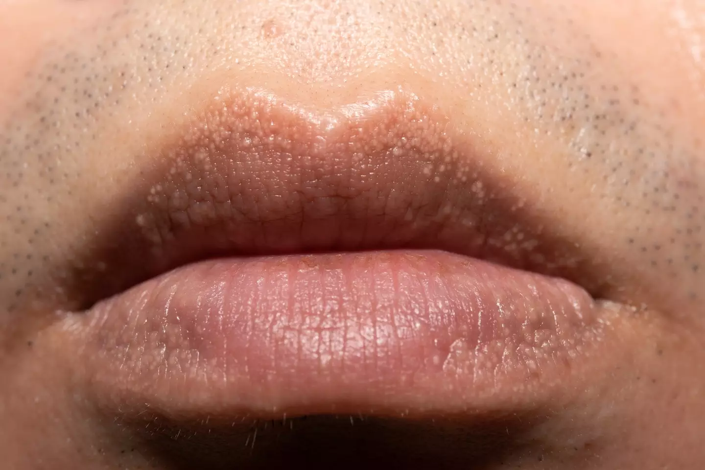 Fordyce spots are small, pale or yellowish bumps that can appear on the skin of the genitals, lips or inside of the mouth (Getty Stock Images)