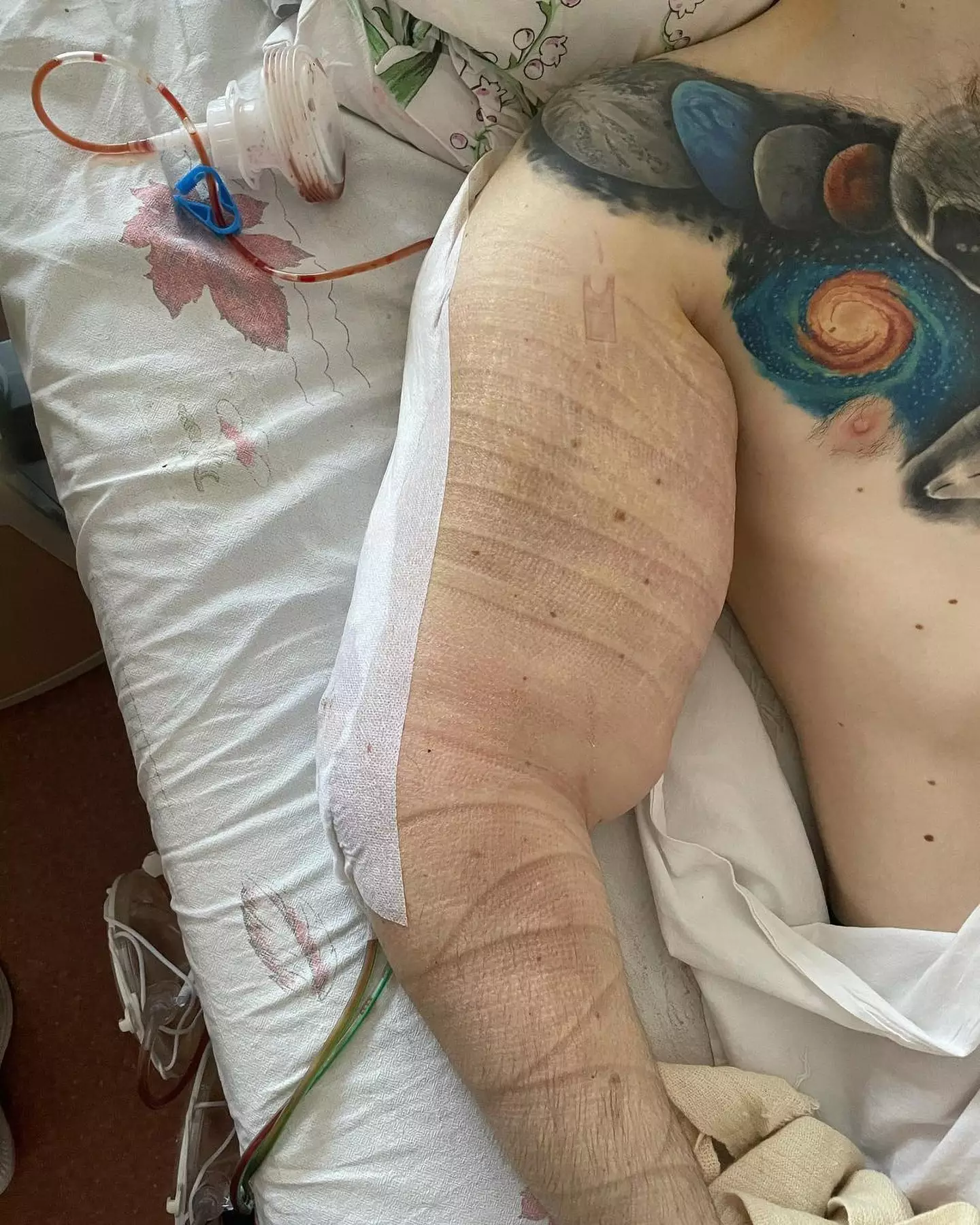 Doctors have reportedly warned him that a severe infection means they might need to amputate his arms (@ruki_bazuki_official/NewsX)