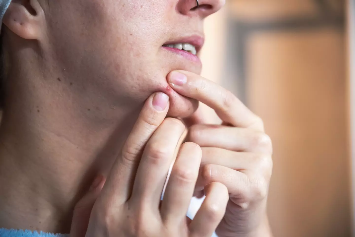 Popping pimples can leave long-lasting scars. (Getty Stock Photo)