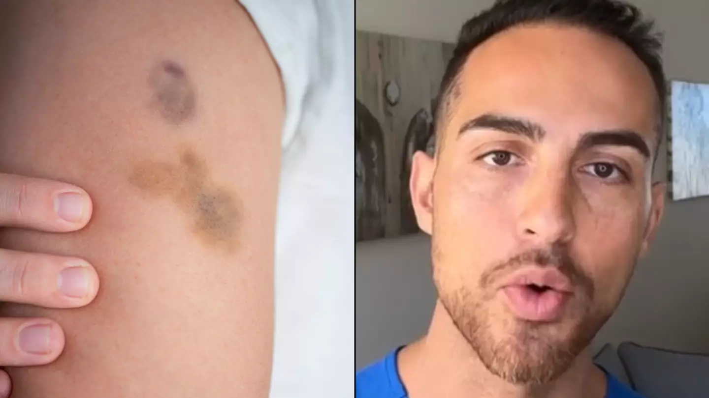 Doctor explains why some people get frequent or unexplained bruising and when to seek help