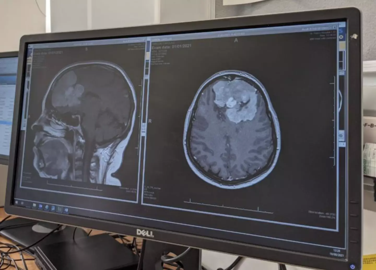 They found a tumour following the CT scan. (St. George's Hospital)