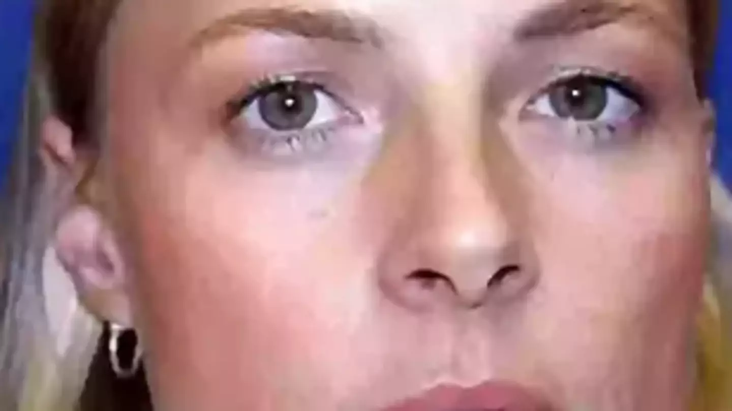Expert reveals long-term impact of botox as one identical twin used it and other didn’t
