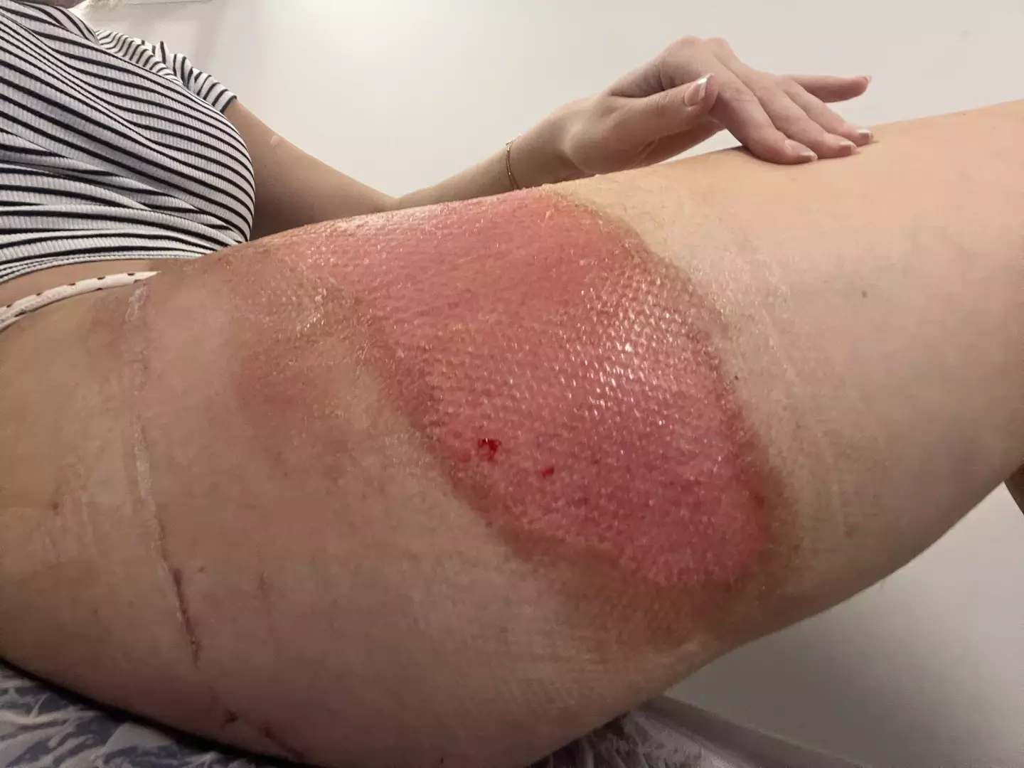 Annie suffered horrendous burns after her water bottle split (Kennedy News and Media)