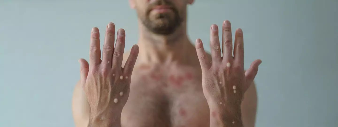 Blistering on the hands is a sign of mpox (Getty Stock Images)