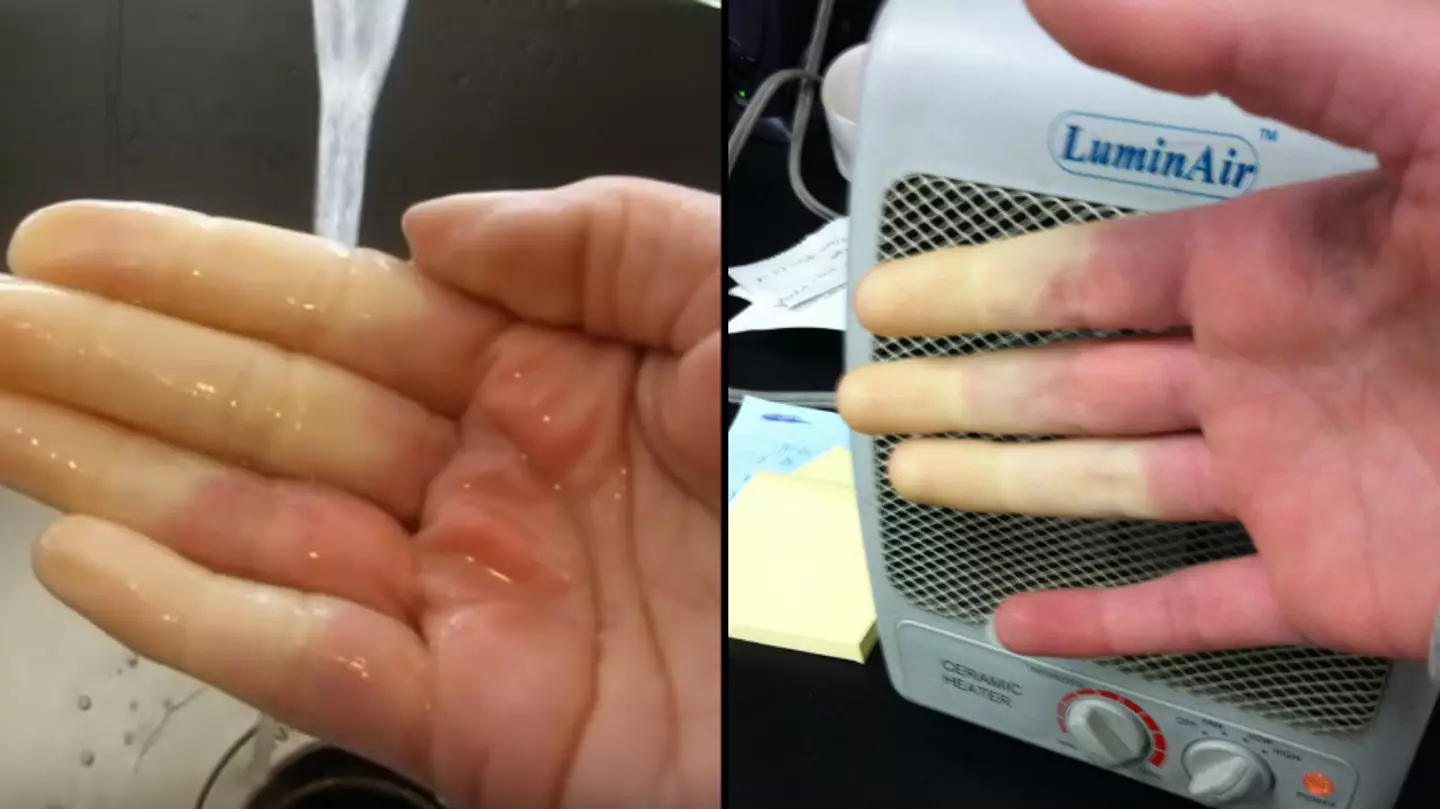 Disorder that makes your hands turn white or blue when it's cold affects millions
