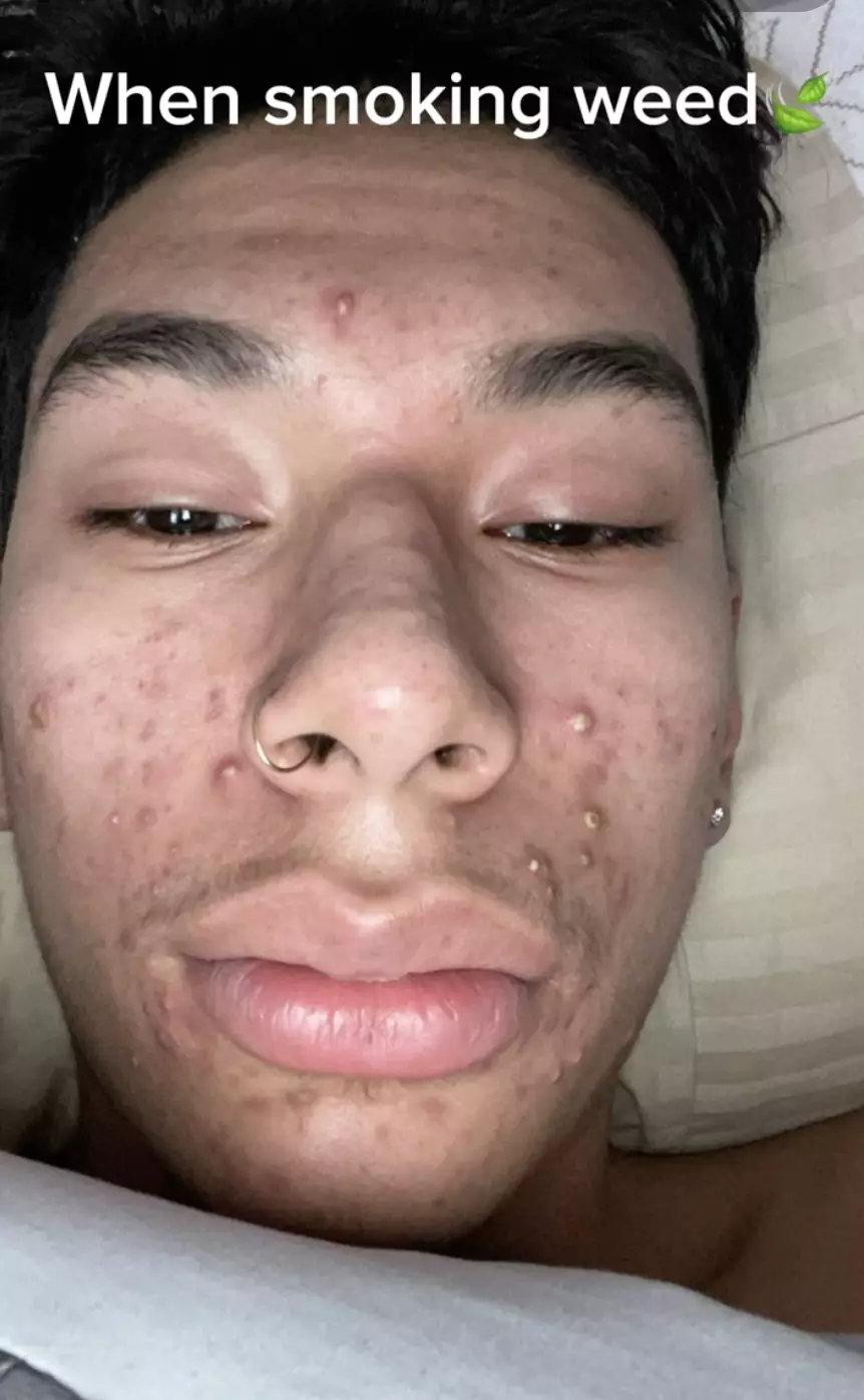 The YouTuber said he used to get multiple whiteheads after smoking cannabis (YouTube/Patrick Merino)