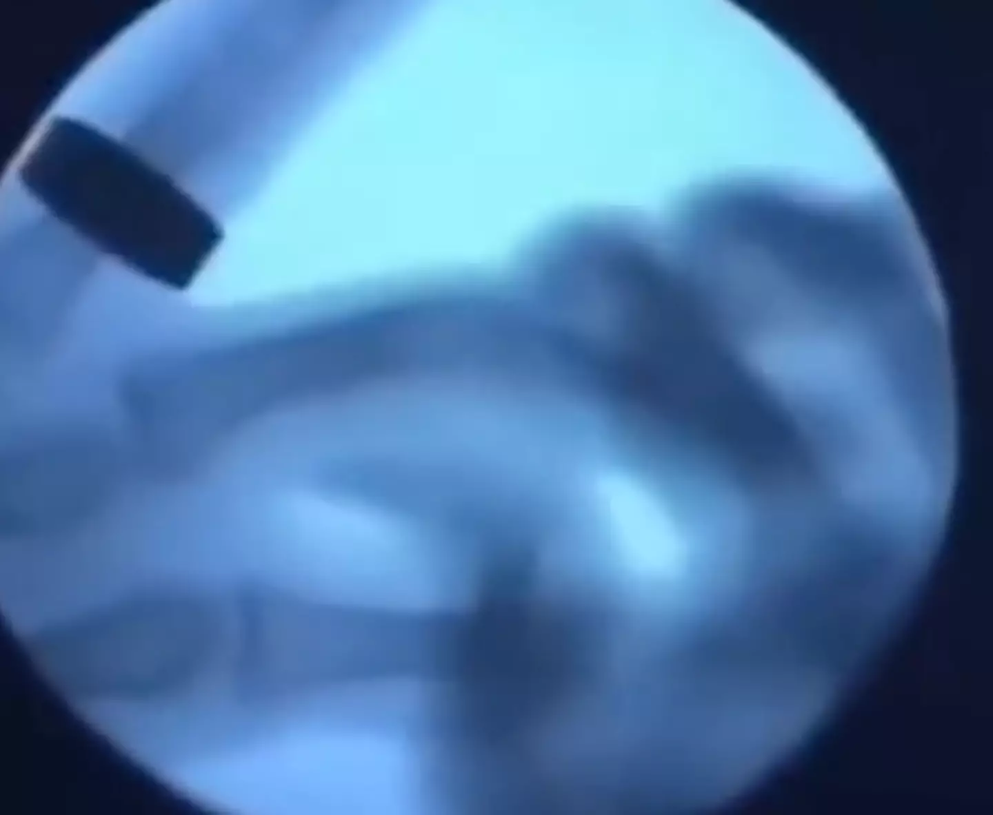 The clip shows an X-ray video of finger knuckles being cracked.