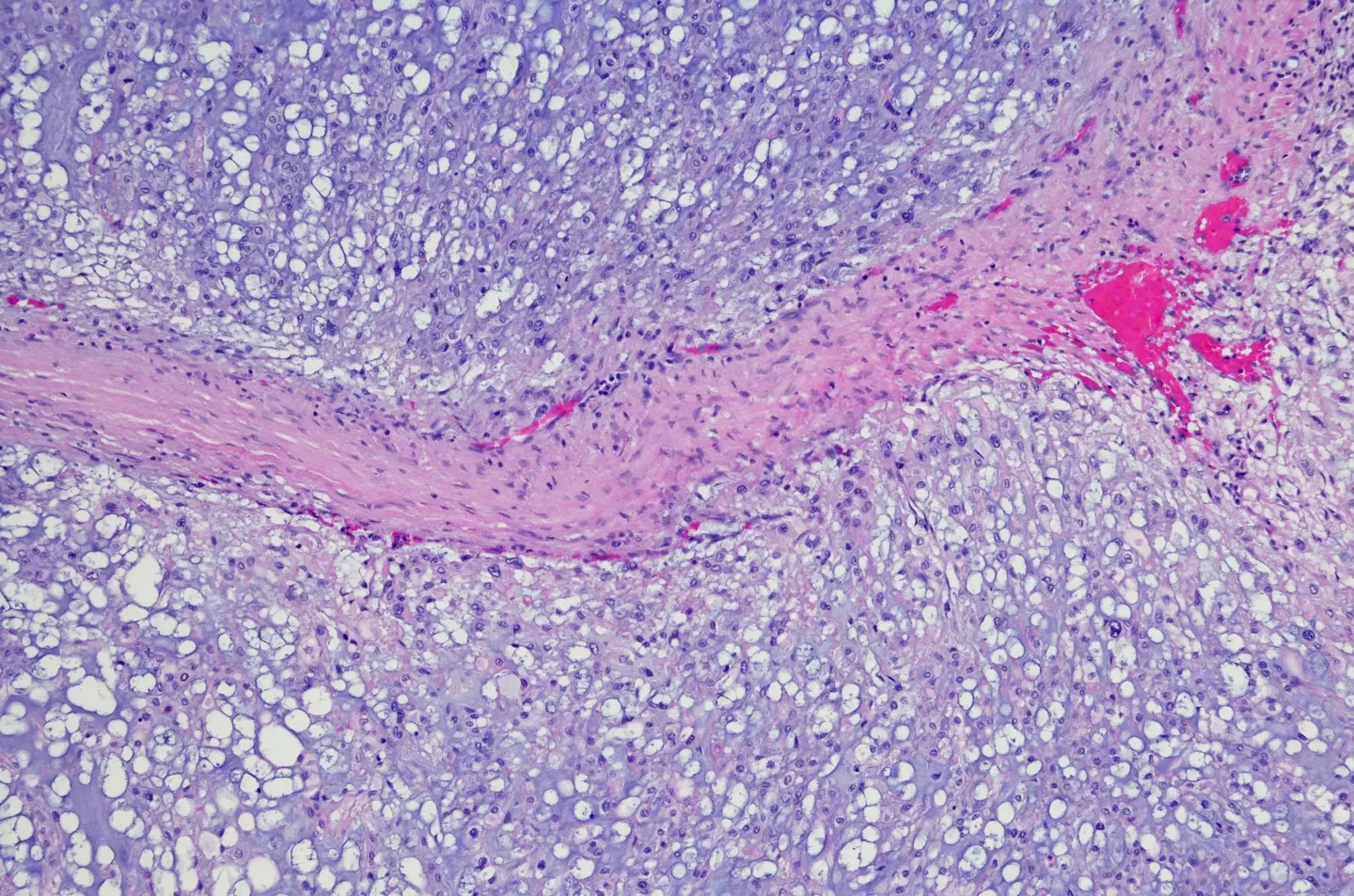 Chordoma is a very rare form of bone cancer (Getty Stock Images)
