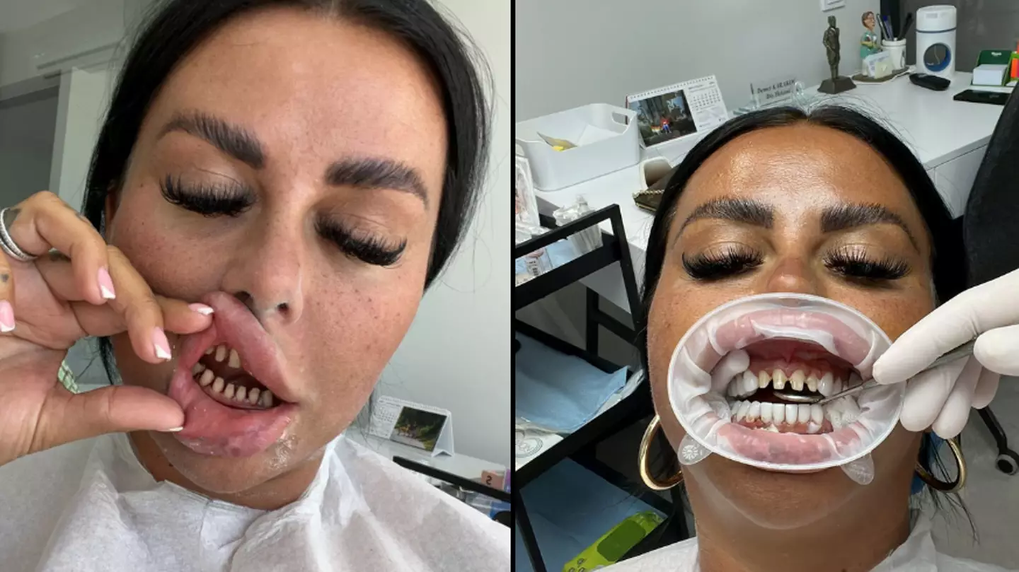 Woman says her £4000 ‘Turkey teeth’ ruined her life