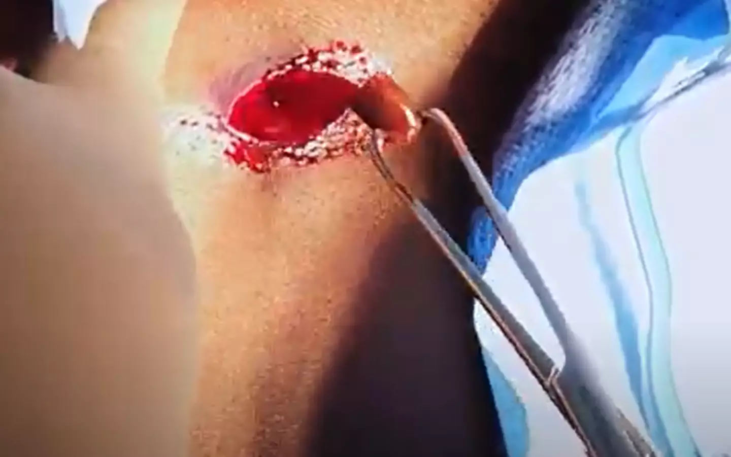 Dr Crawford freed her of the bullet after so many years.