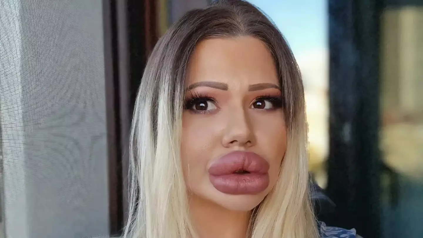 Woman with 'world's largest lips' shares what she looked like before surgeries