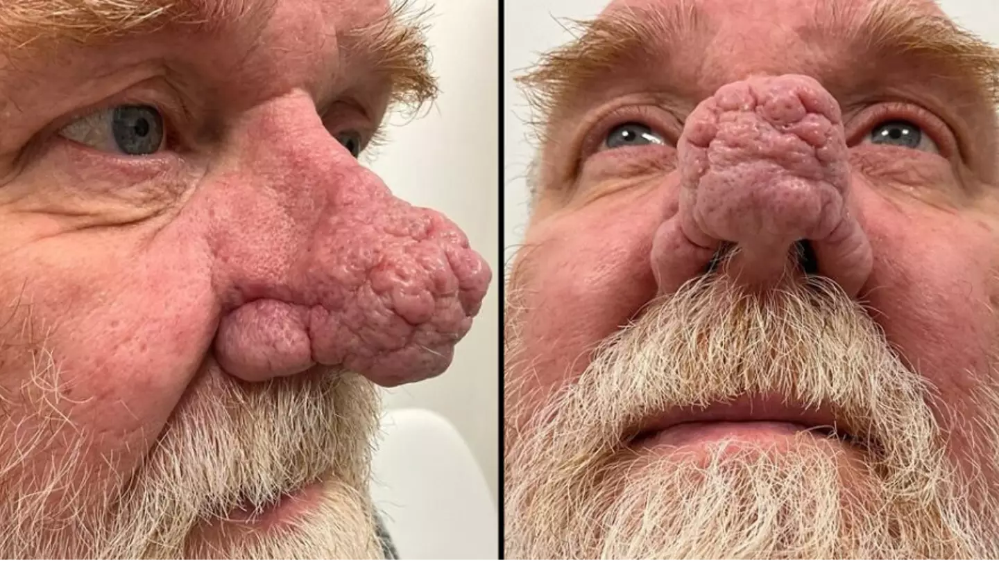 Man thought his ‘nose would fall off’ before finally receiving diagnosis