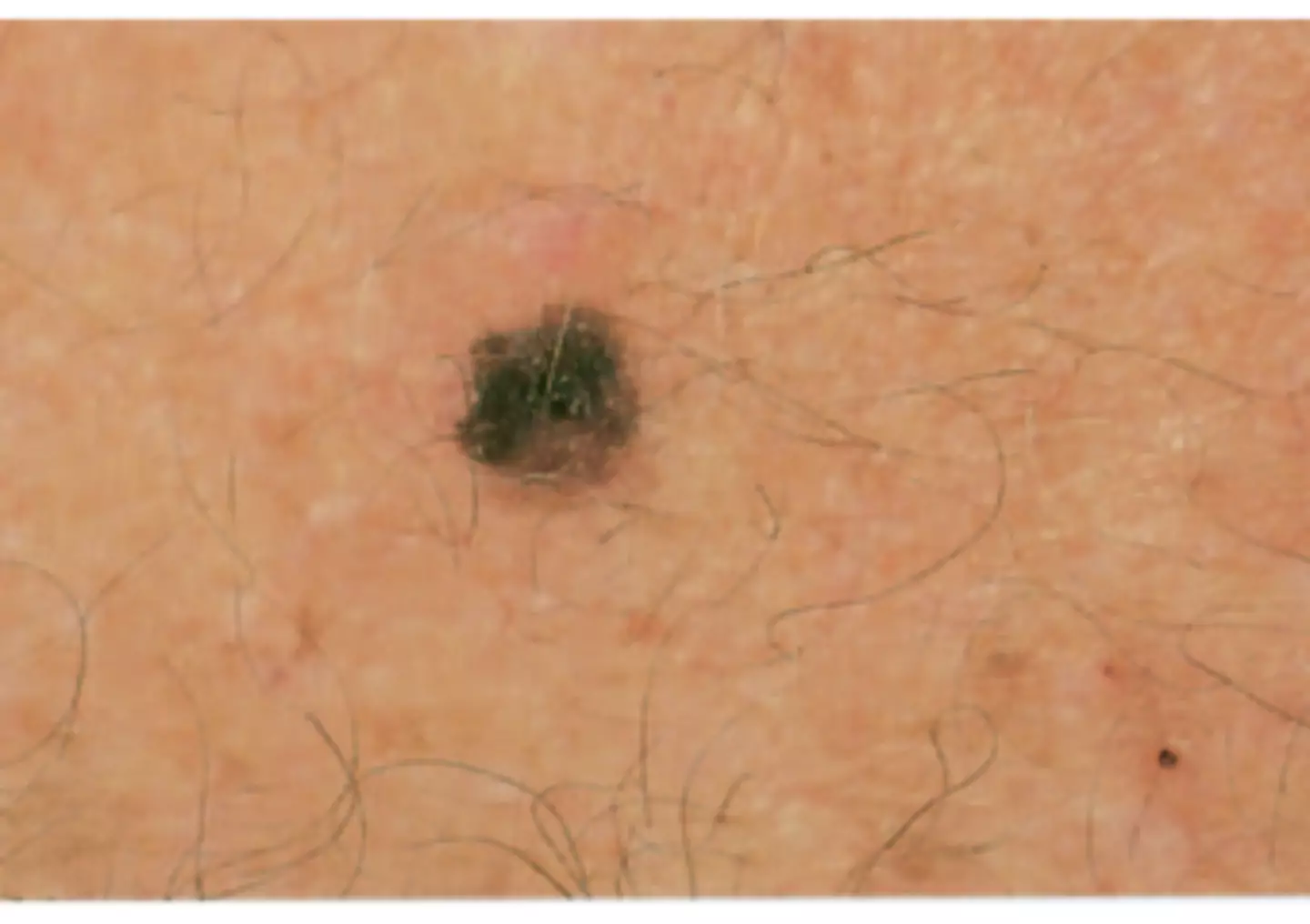 E is for Evolving (Skin Cancer Foundation)