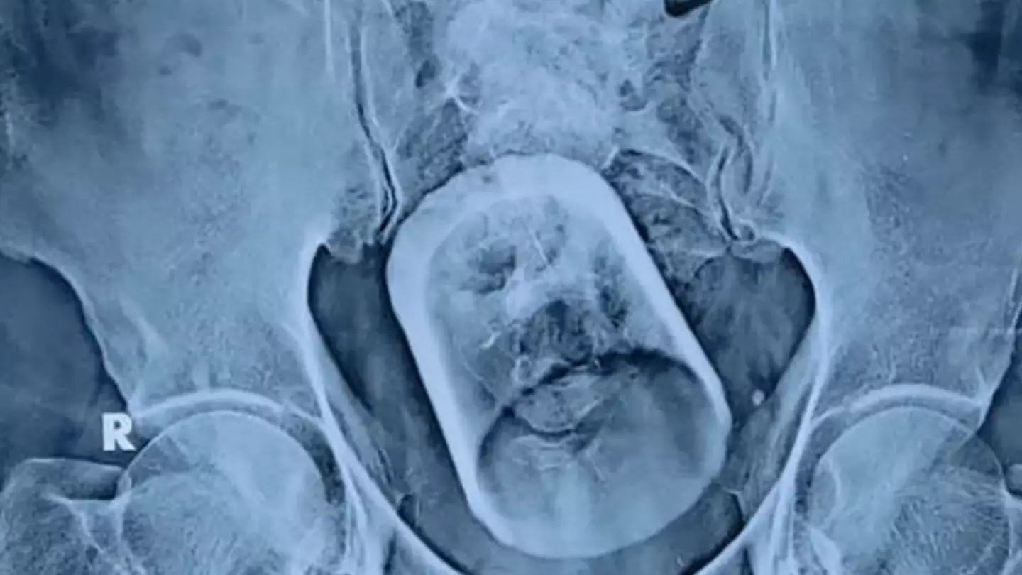 Doctors Find Whole Glass Stuck In Rectum Of Man After He ‘Accidentally Swallowed It’