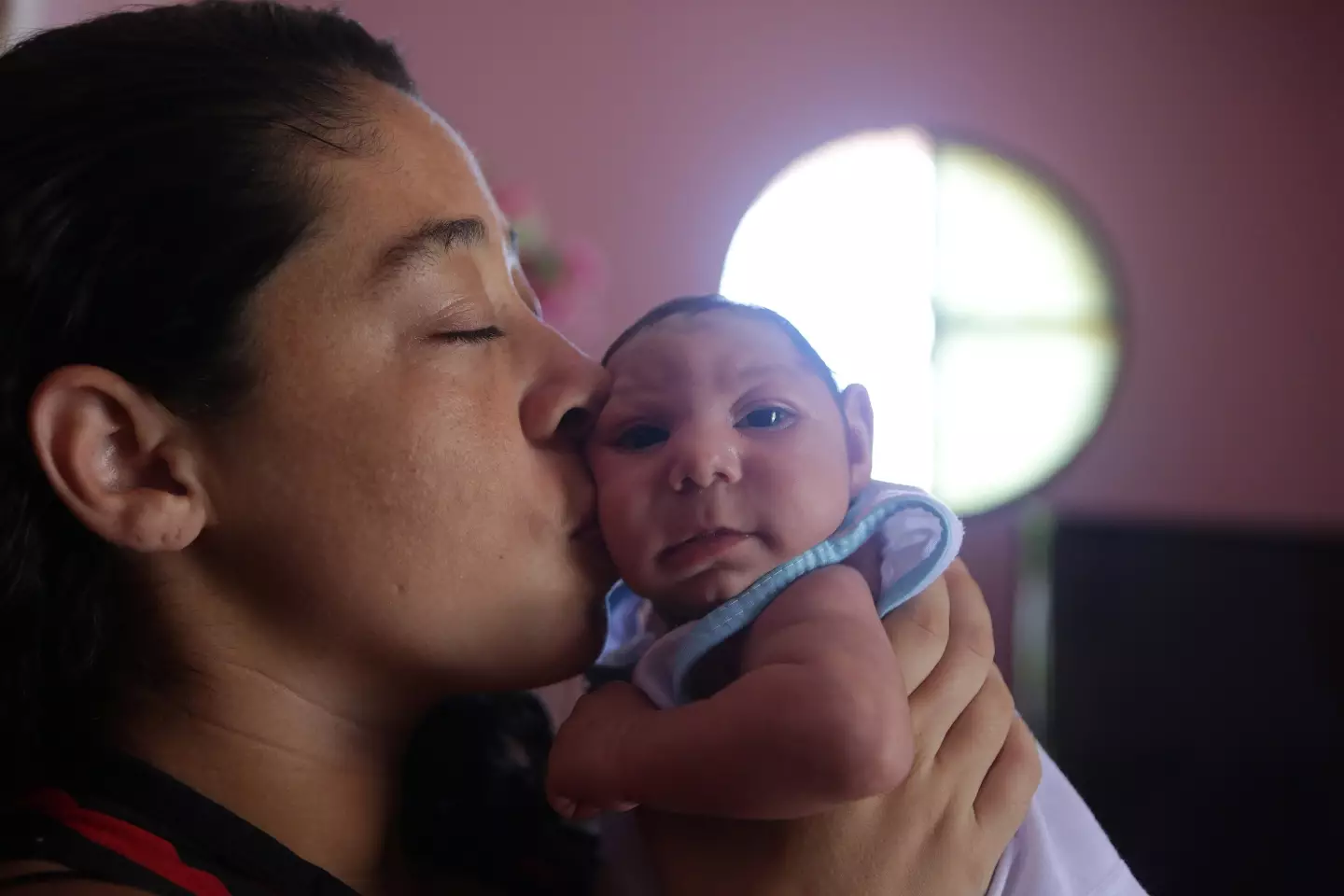 Baby with microcephaly related to the Zika virus. /