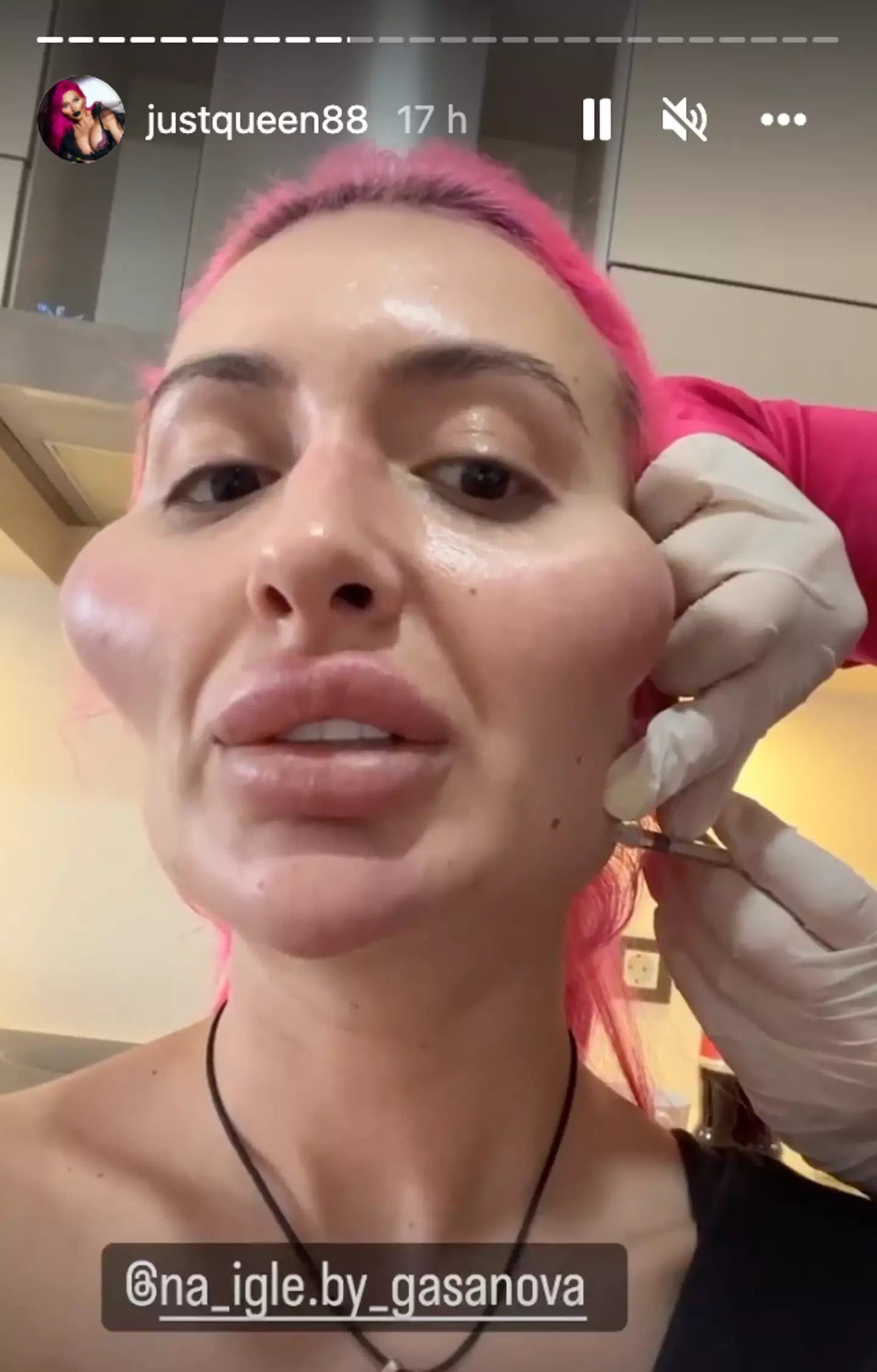The model took to Instagram Stories to reveal her latest procedure.
