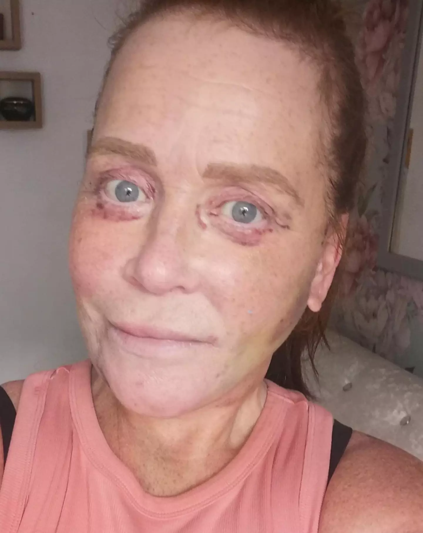 Her eyes started to swell up (Kennedy News and Media)