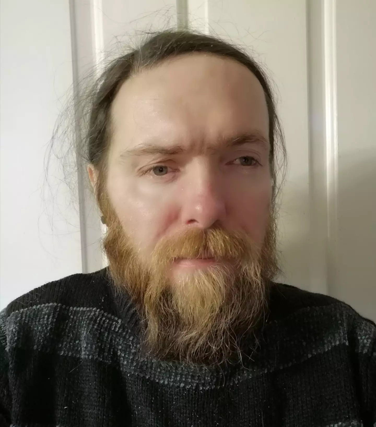 Jay Short has been turned down for numerous jobs which he believes is due to his facial disfigurement.